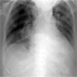 Thumbnail Graphic -- Pneumothorax after a Common Procedure