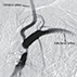 Thumbnail Graphic -- Subclavian Steal Syndrome