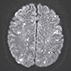 Cerebral Fat Embolism
