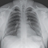 Bilateral Anterior Shoulder Dislocation Bilateral Anterior Shoulder Dislocation
