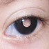 Retinoblastoma
