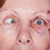 Traumatic Abducens Nerve Palsy