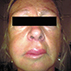 Disfiguring Angioedema