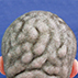 Cutis Verticis Gyrata