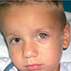 Mydriasis in the Garden